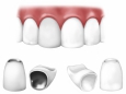 Коронки на зубы